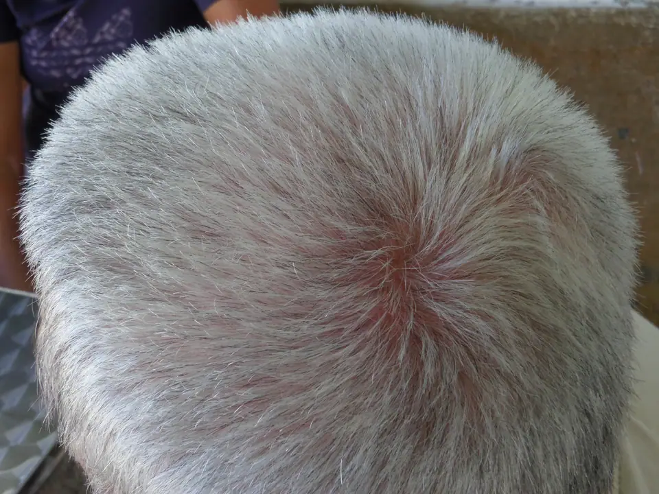 Coronilla de una persona vista desde arriba, con el pelo corto casi todo blanco y canoso