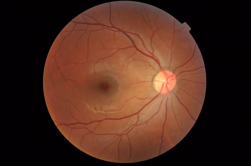 Fotografía del fondo de un ojo sano: la retina anaranjada con sus vasos sanguíneos, la mácula oscura en el centro y, a la derecha, el disco óptico, la mancha clara donde sale el nervio óptico