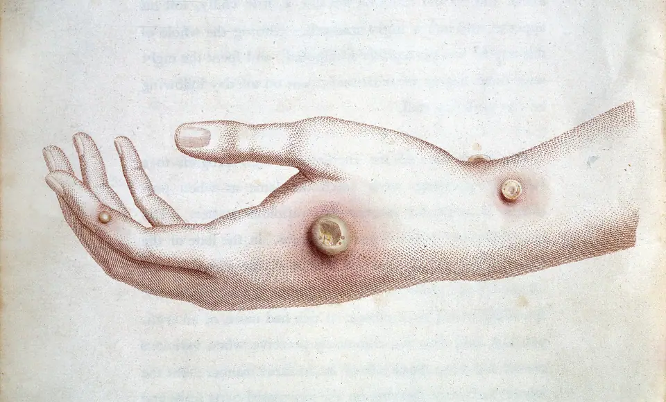 Grabado de 1798 del libro de Jenner: la mano de la lechera Sarah Nelmes con las pústulas de viruela bovina